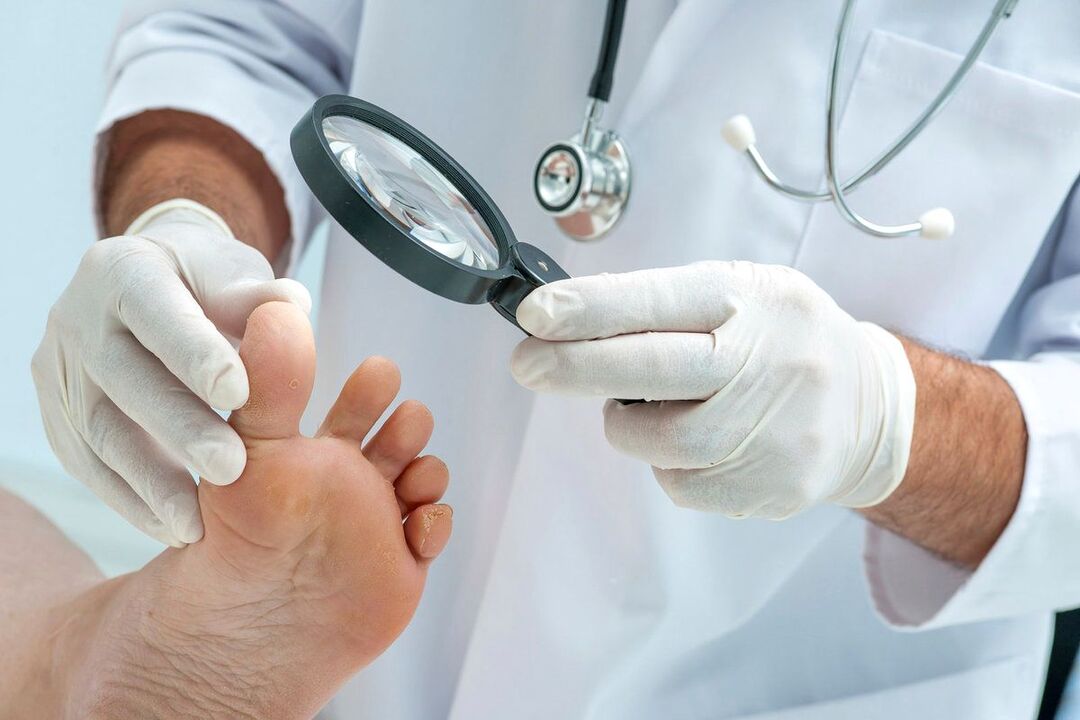 gydytojas apžiūri pėdas su grybeliu