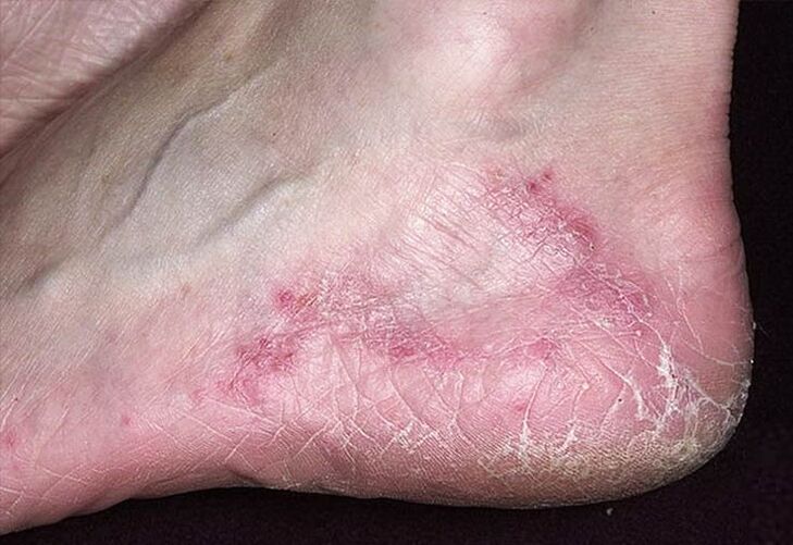 Kulnų odos įtrūkimai ir paraudimas yra grybelinės infekcijos požymiai