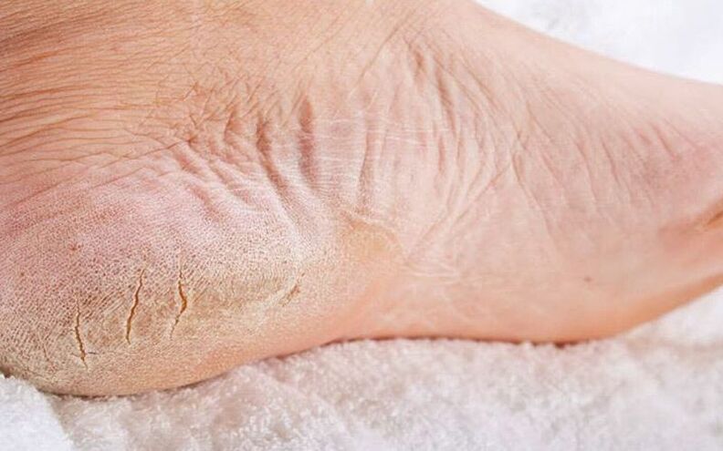 pėdų grybelio simptomai