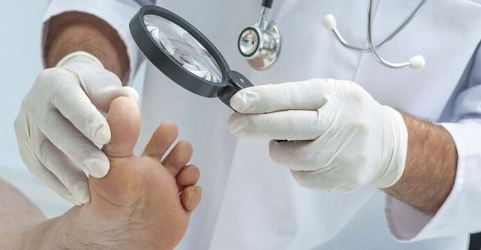 gydytojas tiria kojas dėl nagų grybelio