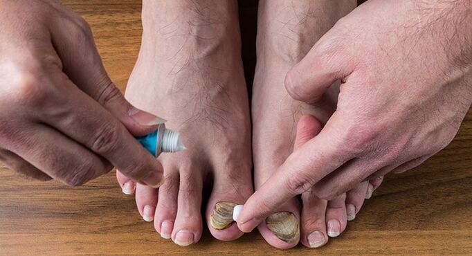 kojų nagų grybelio gydymas
