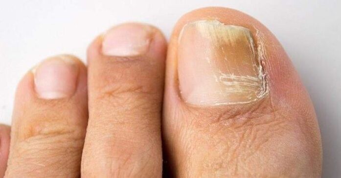 geltonas kojų nagas su grybeline infekcija