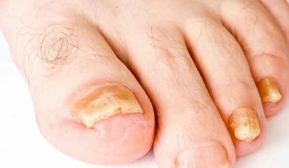 geltoni kojų nagai nuo grybelinės infekcijos