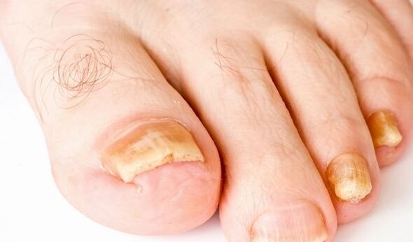 kojų nagų grybelio simptomų nuotrauka